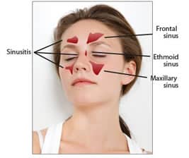close up of woman's face as she looks up with eyes close and written diagram of her sinus with words with small illustration