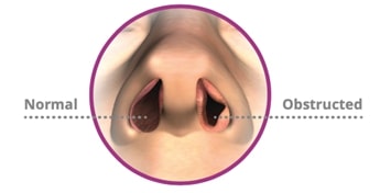 Nasal Obstruction in Great Neck, NY